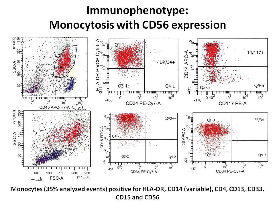 Bone marrow aspirate flow phenotype